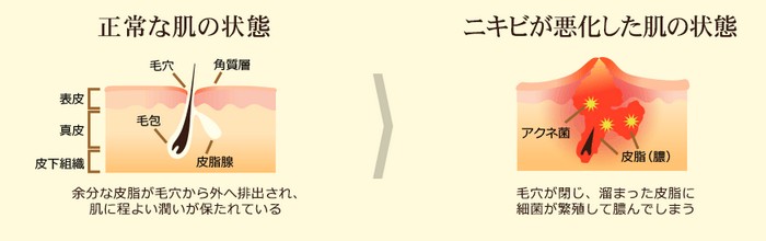 �A�N�l�N���A���[�V�������`�y�Z�������e�t